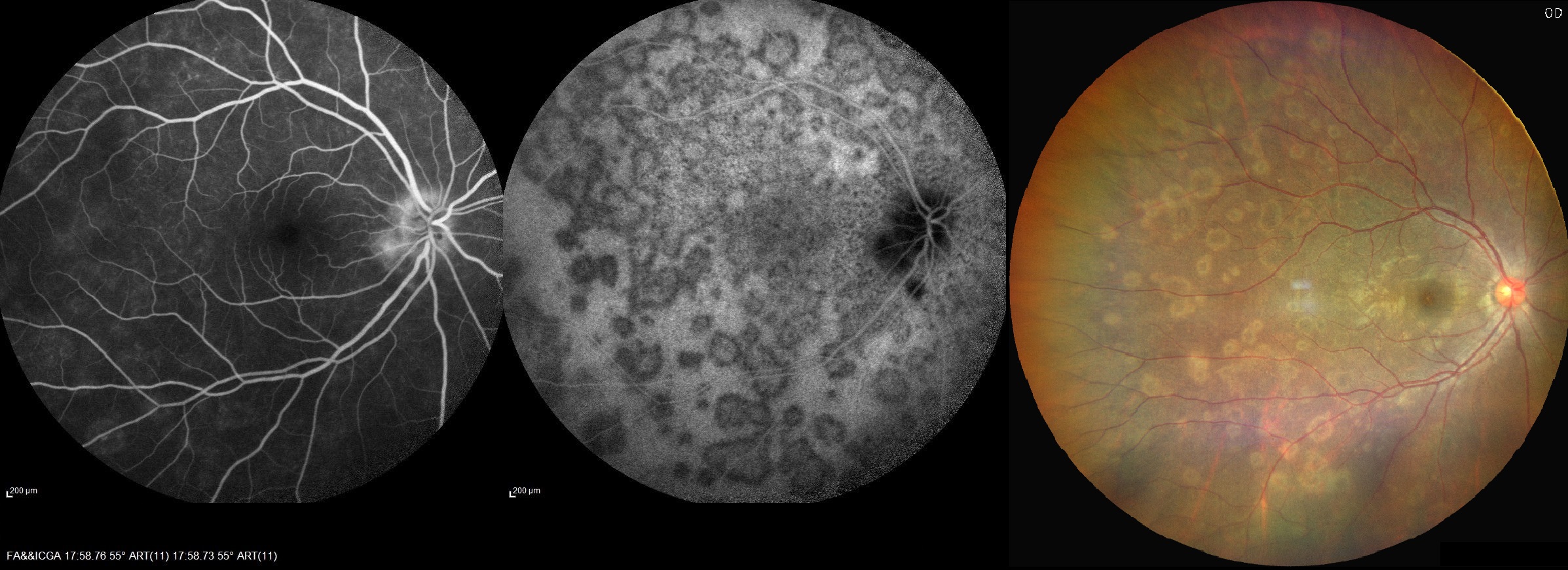 FA (A), ICGA (B) and color fundus photo (C) of the right eye of a patient with MEWDS