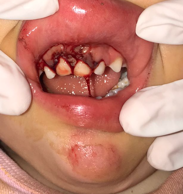 <p>Alveolar Fracture of the Anterior Segment