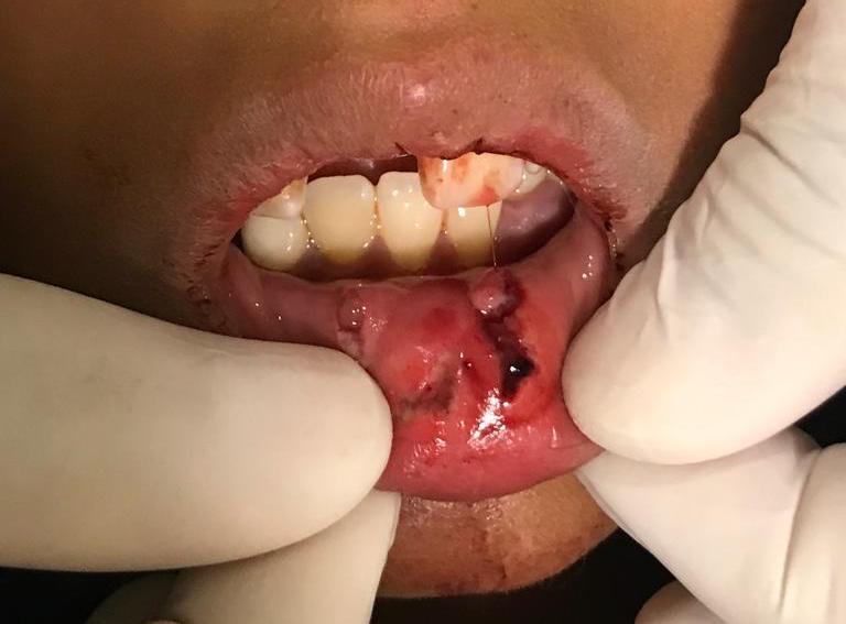 <p>Deep Laceration of Lower Lip After Trauma. The 11 was avulsed.</p>