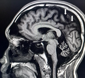 MRI findings in posterior cortical atrophy