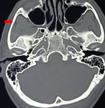 <p>Zygomatic Arch</p>