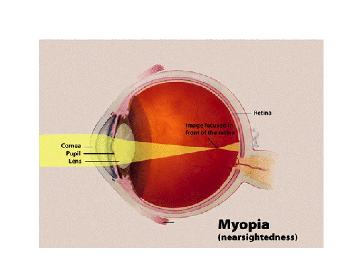 <p>Myopia or Near Sightedness.</p>