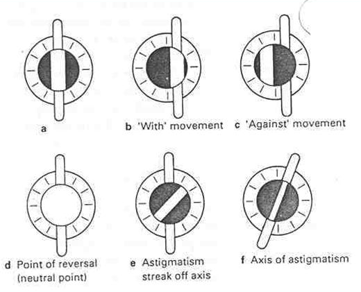 <p>Steps of Retinoscopy.</p>