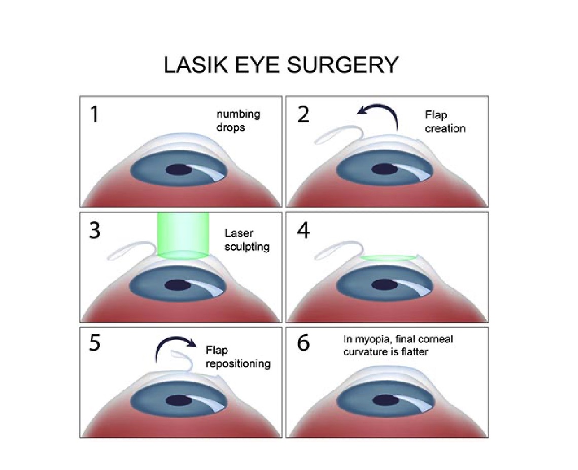 <p>Steps of LASIK Eye Surgery.</p>