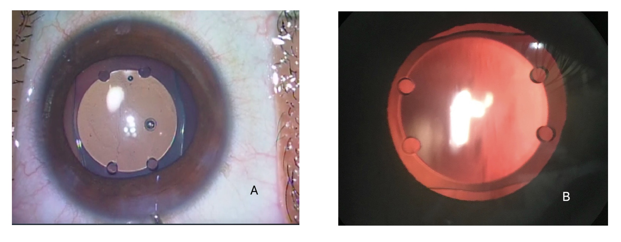 <p>Phakic Intraocular Lens