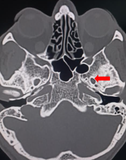 <p>Foramen Ovale, Computed Tomography.</p>