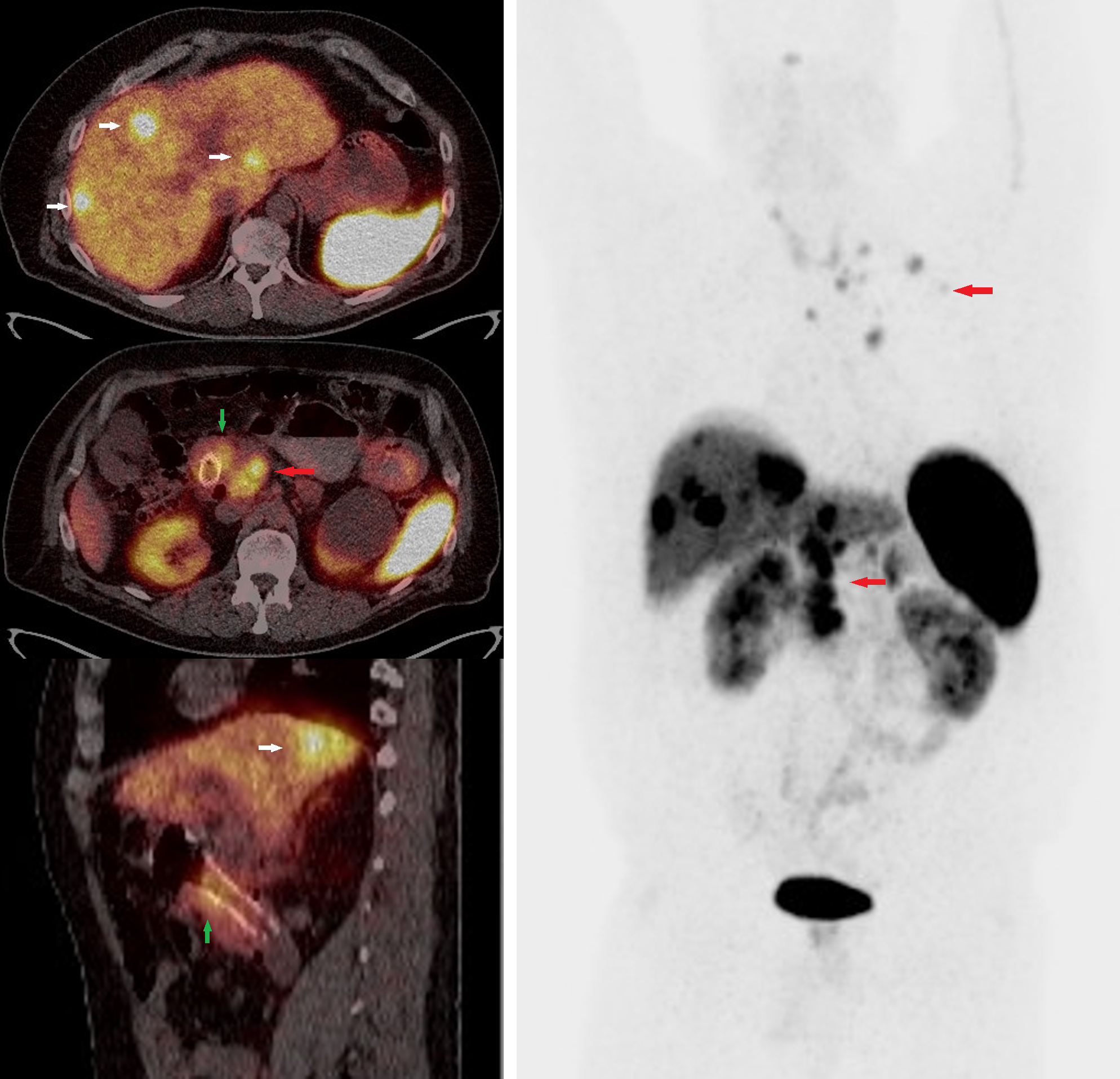 Figure 4: Ga68 DOTATOC PET/CT whole-body scan fused and MIP images of a patient with well-differentiated grade 2 neuroendocrine tumor of the duodenum with metastatic disease to the liver and lymph nodes