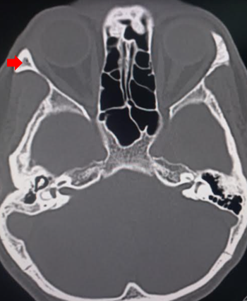 <p>Zygomatic Bone</p>