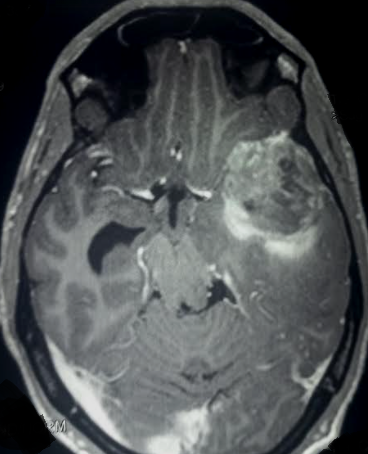 Contrast MRI in a patient presenting with features of partial kluver bucy syndrome due to herpes encephalitis