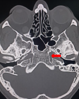 Foramen lacerum