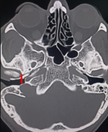 Jugular spine