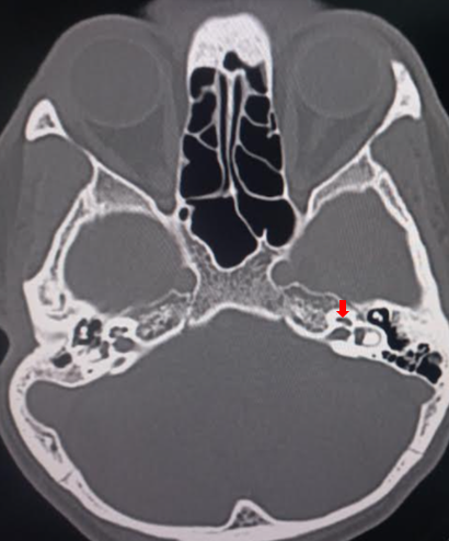 <p>Cochlea,&nbsp;Computed Tomography.</p>