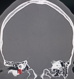 <p>Cochlea, Coronal Computed Tomography.</p>