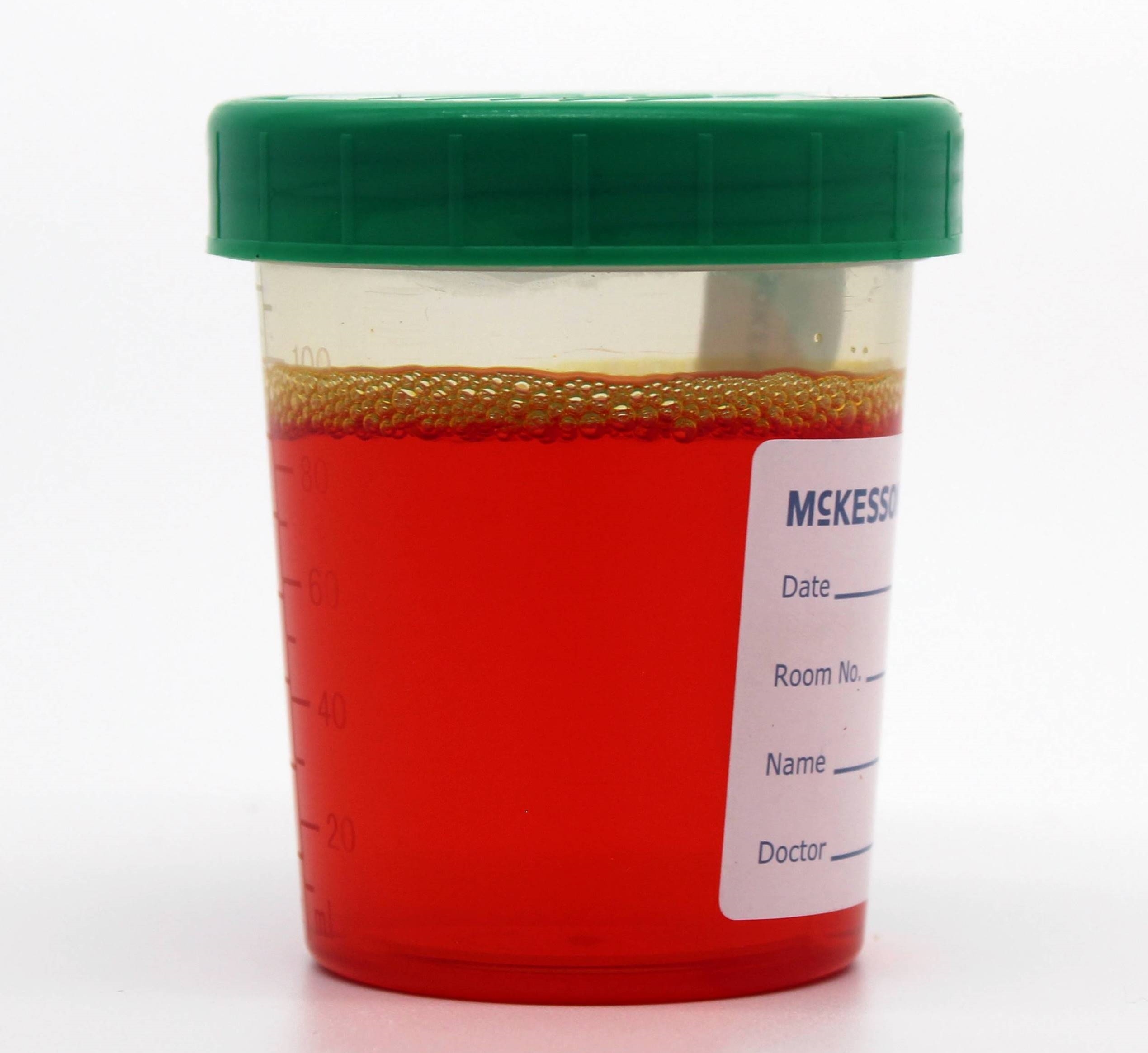 <p>Urine Colored With Phenazopyridine</p>