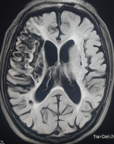 <p>Encephalomalacia Following Ischemic Stroke</p>