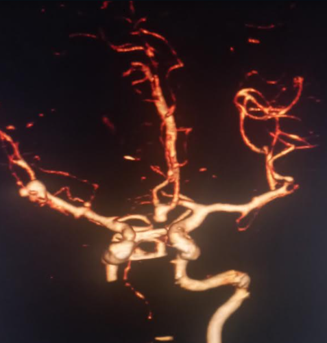 <p>Multiple Intracranial Saccular Aneurysms