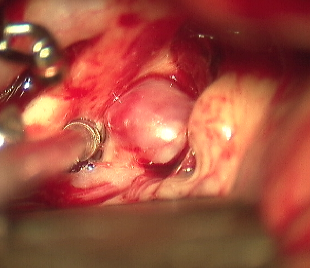 <p>Saccular Anterior Communicating Artery Aneurysm (ACOM) Visualized Intraoperatively