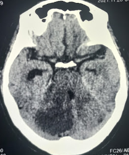 <p>Acute Cerebellar Infarction on Computed Tomography