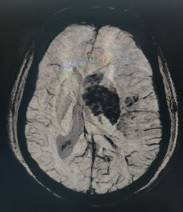 <p>Hemorrhagic Transformation Within the Left&nbsp;Middle Cerebral Artery Territory Infarction