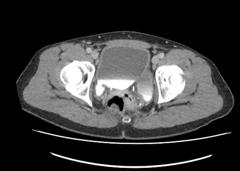 Bladder diverticulum noted during a CT Abdomen/Pelvis