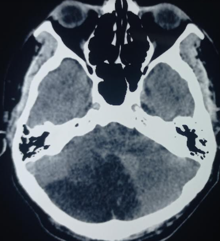 <p>Acute Cerebellar Infarction on Noncontrast Computed Tomography