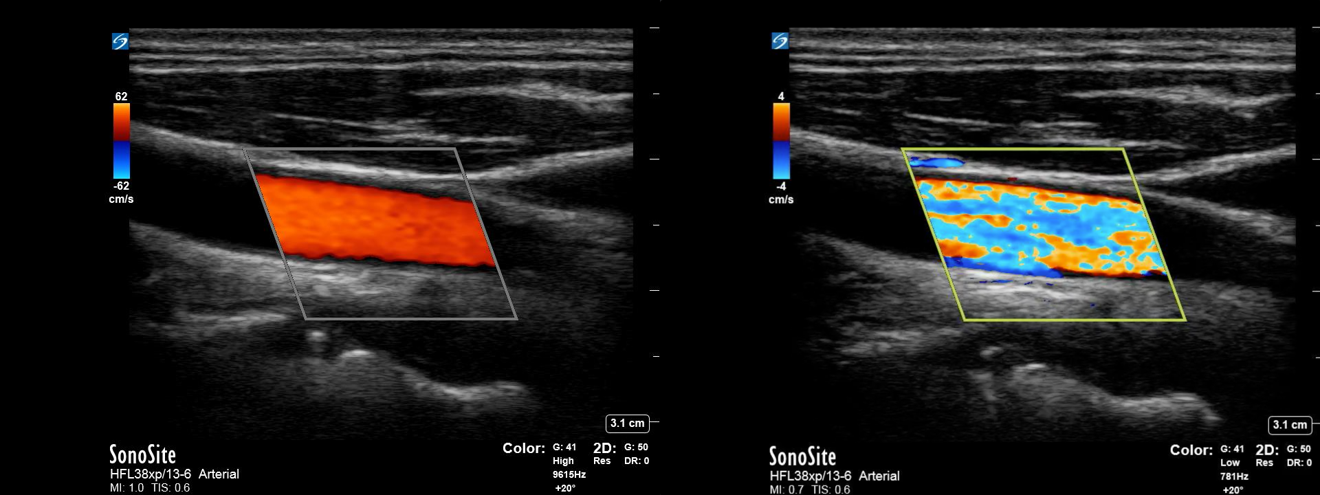 Figure 4: Example of optimized color Doppler imaging of the common carotid artery (left) vs