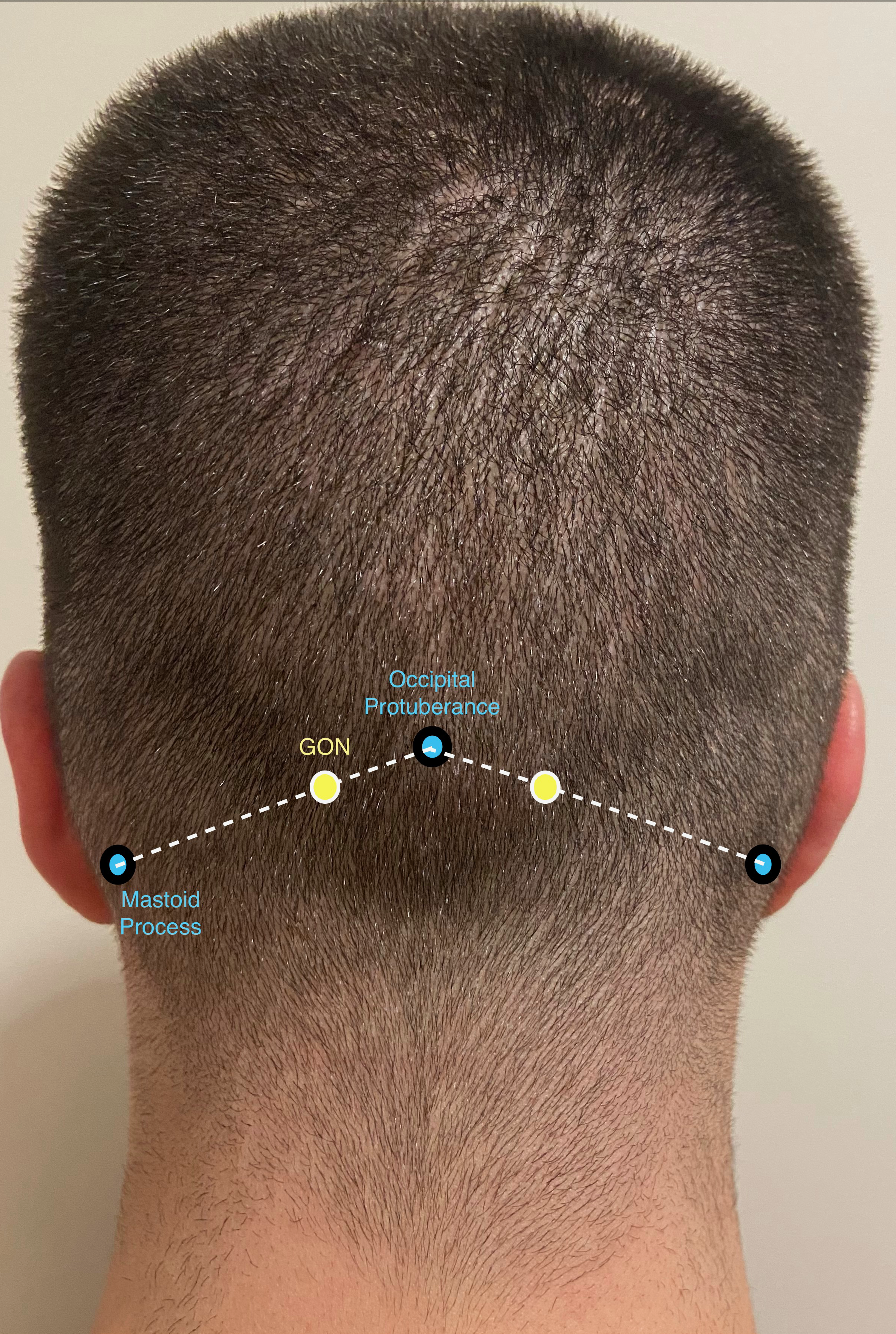 Greater Occipital Nerve Block Anatomy