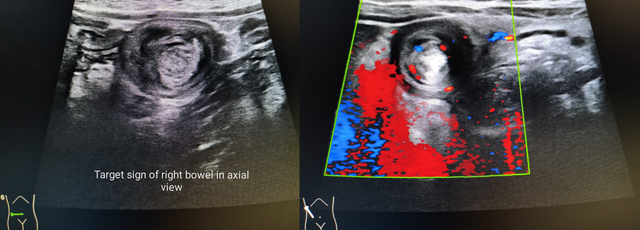 Target sign in intussusception on ultra sound. Doppler shows low vascular flow in the bowel.