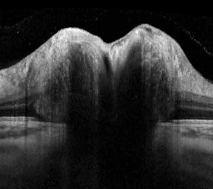 Enhance depth imaging optical coherence tomography revealing disc drusen as areas of hypoechoic cores with hyperechoic margin