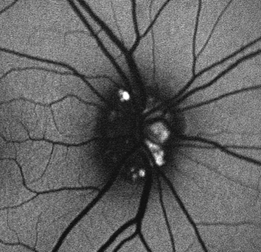 Fundus auto fluorescence revealing multiple optic nerve head drusen.