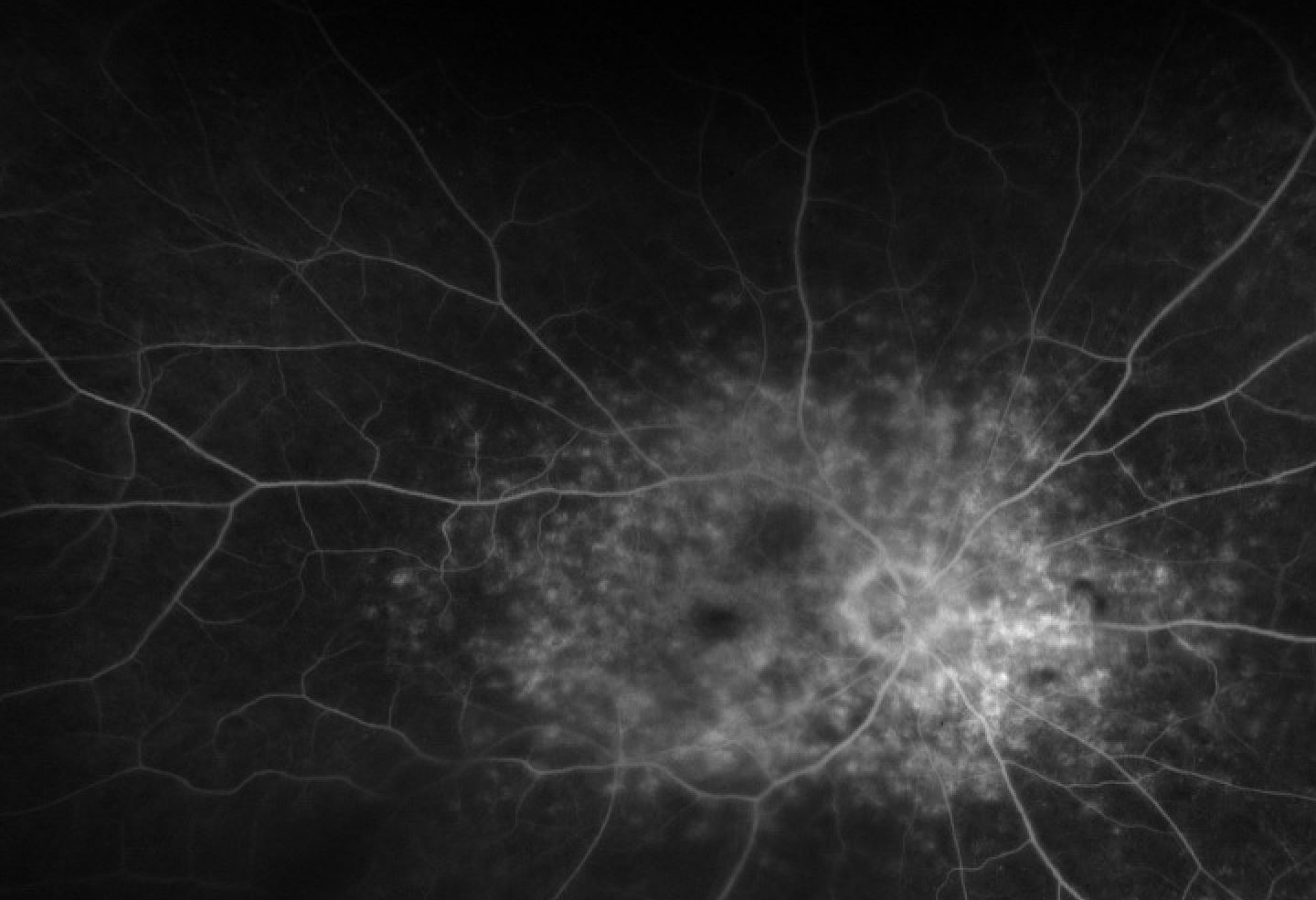 FA images of multifocal pattern dystrophy