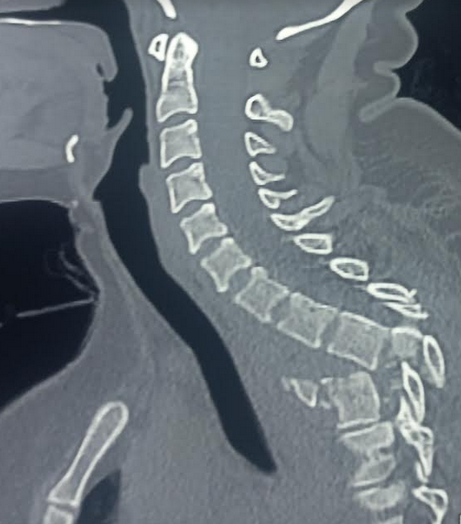 Traumatic spondyloptosis of the thoracic spine