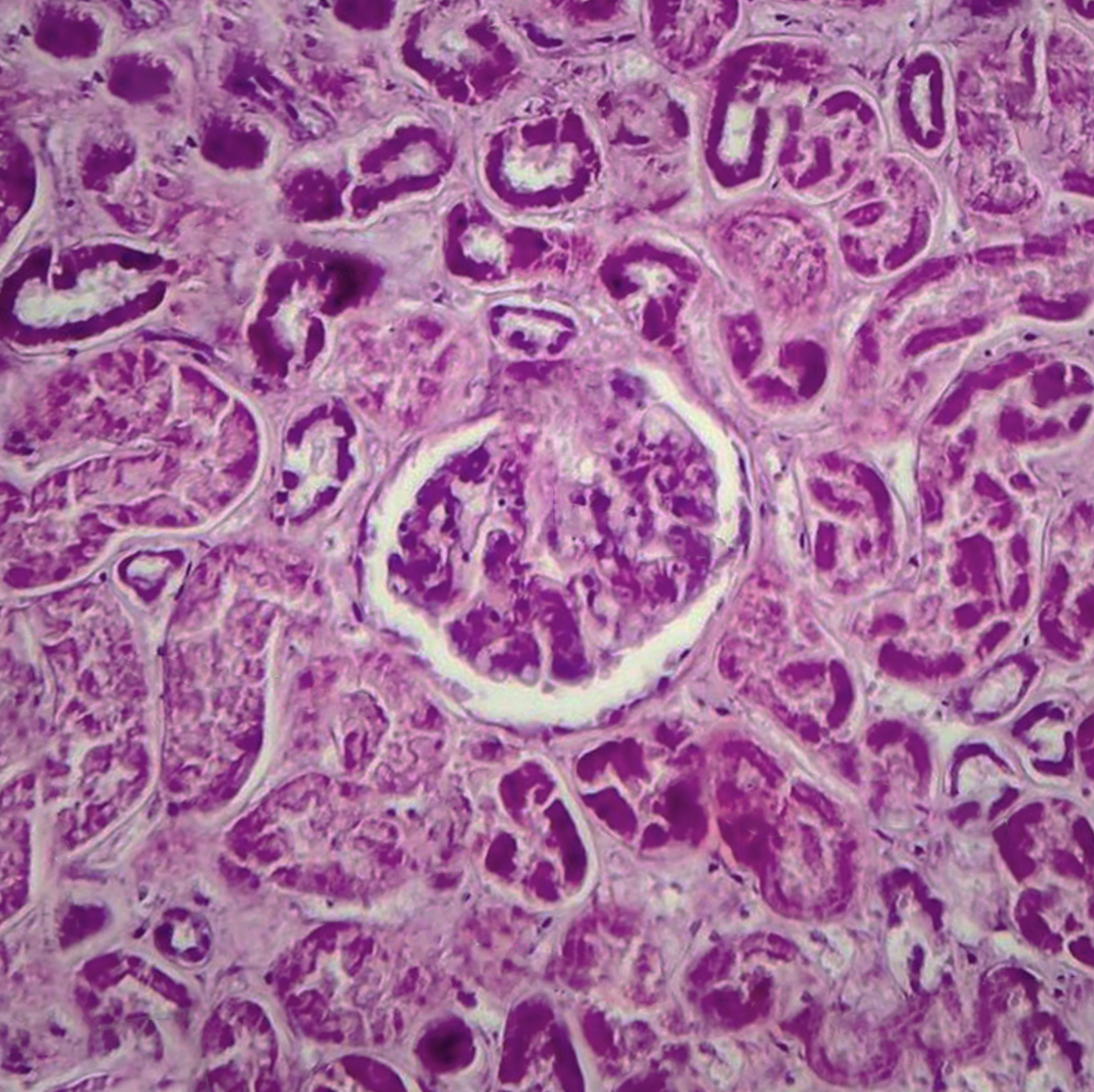 Histology of diffuse proliferative glomerulonephritis.