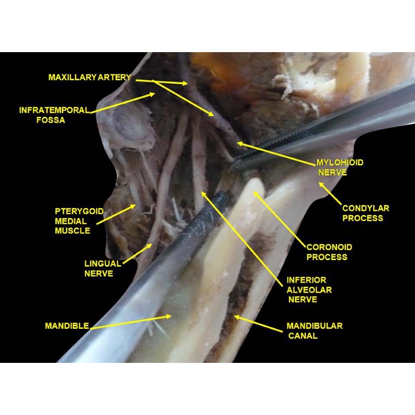 <p>Anatomical Dissection,&nbsp;Lingual Nerve</p>