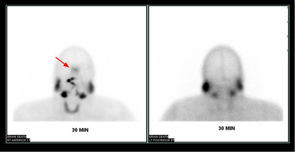 <p>Brain Death Assessment Using Tc99m-Pertechnetate SPECT Imaging