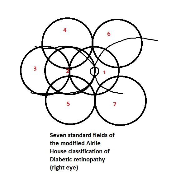Standard seven fields of the modified Airlie House classification of diabetic retinopathy. Each image is of 30-degree. Field 1 is centered at the optic disc and field 2 is centered at the fovea.