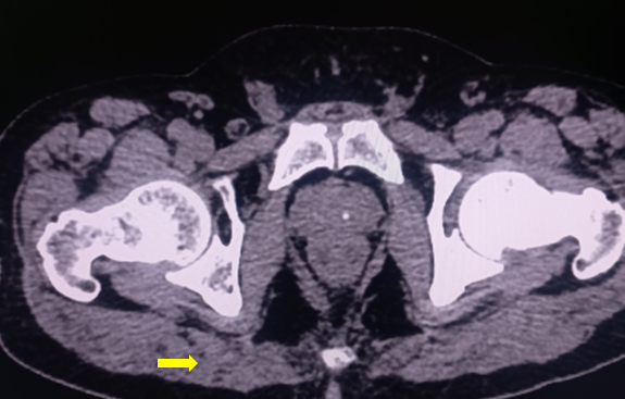 Gluteus maximus