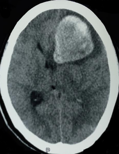 Intratumoral bleed causing subfalcine herniation