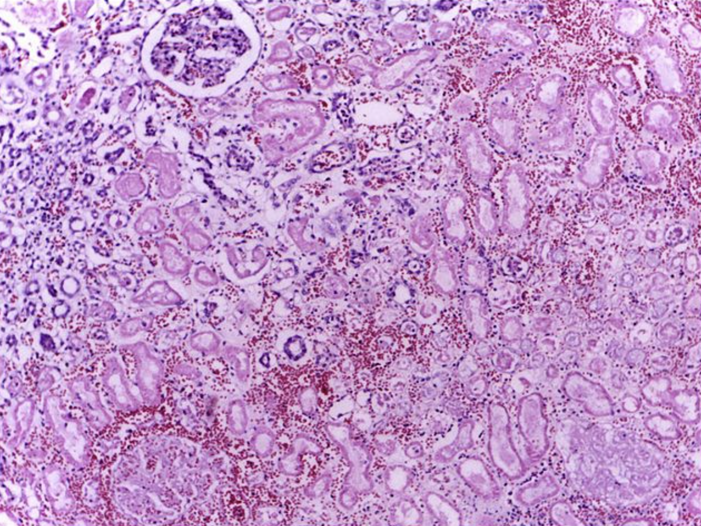 <p>Renal Tissue Necrosis