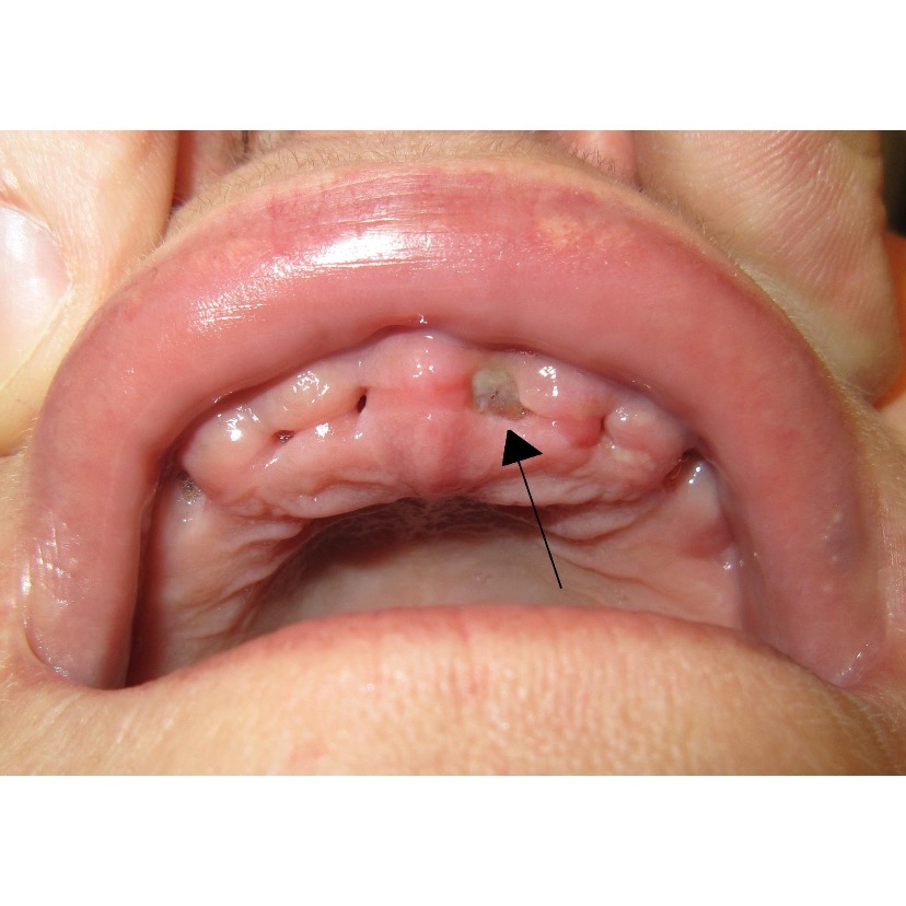 Alveolar osteitis (dry socket).