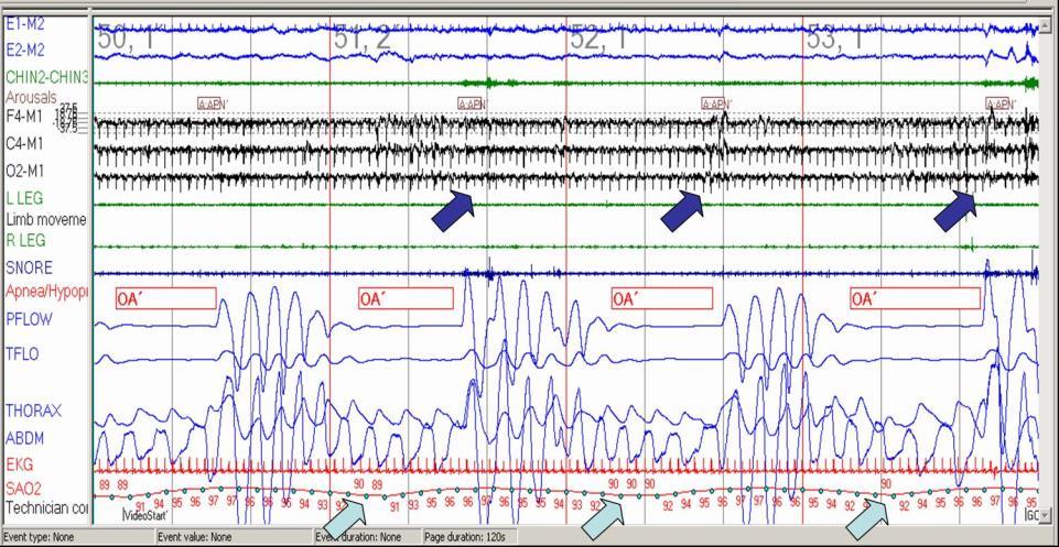 A polygraph recording during sleep. The  panel shows electroencephalogram (EEG), Electrooculogram (EOG), electrocardiogram (ECG), in addition to chin electromyogram (EMG) during 120 seconds window. Note the repetitive obstructive apnea (OA) with persistent effort during cessation of both flow channels [nasal pressure flow (P-flow) and thermester ( T-flow)] followed by desaturation (light blue arrows) ad arousals (dark blue arrows). 