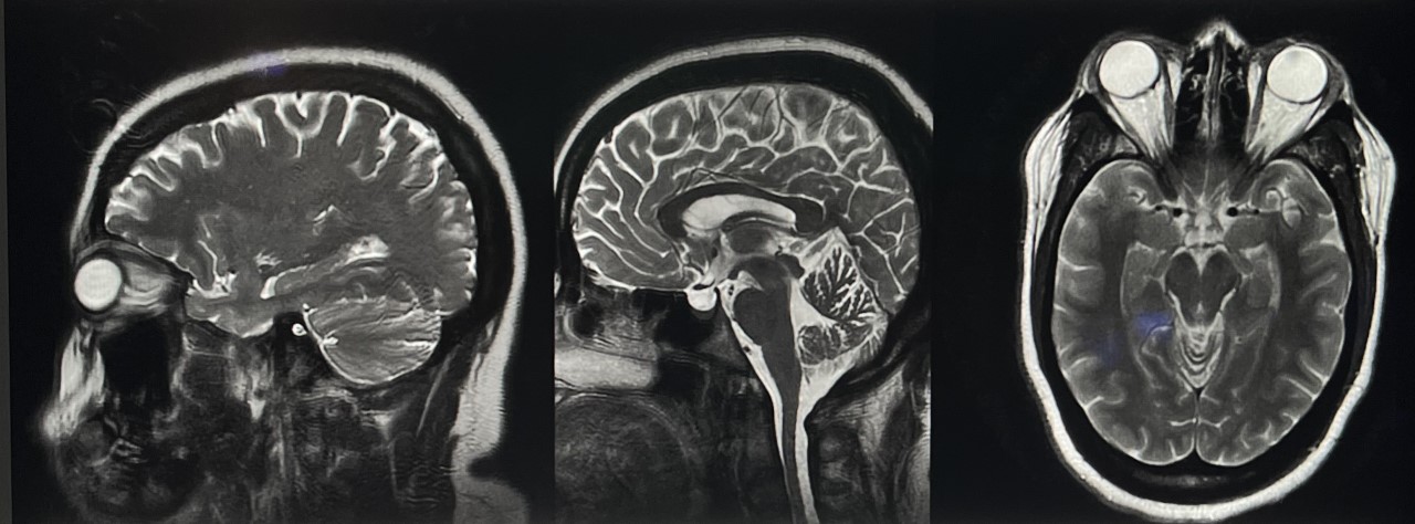 <p>Idiopathic Intracranial Hypertension MRI