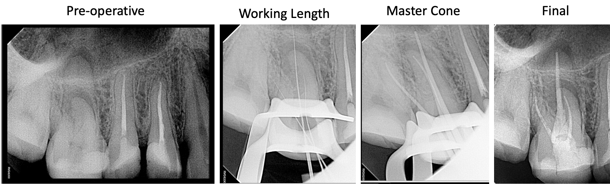 Apical radiolucency with completed treatment.