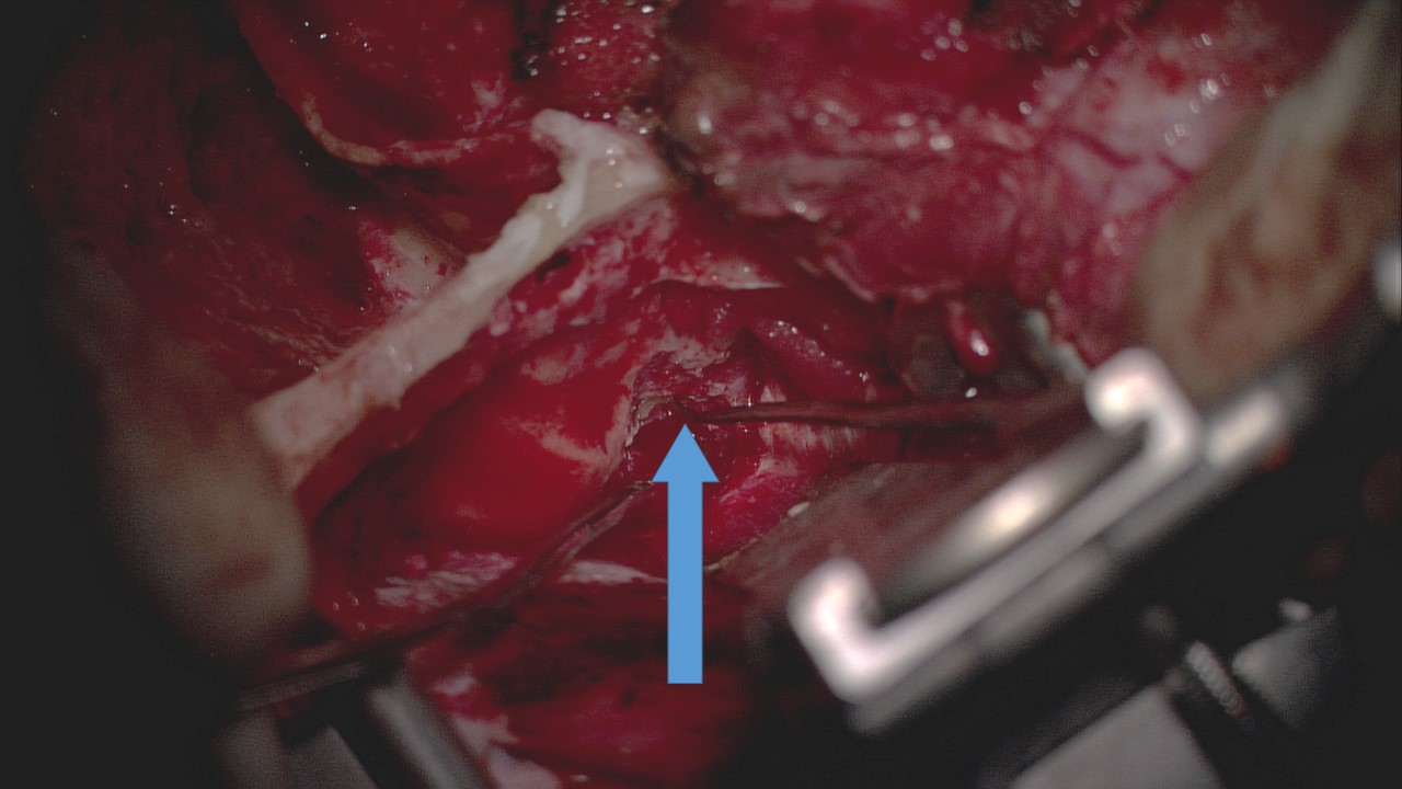 <p>Middle Fossa Craniotomy Approach to Facial Nerve Decompression