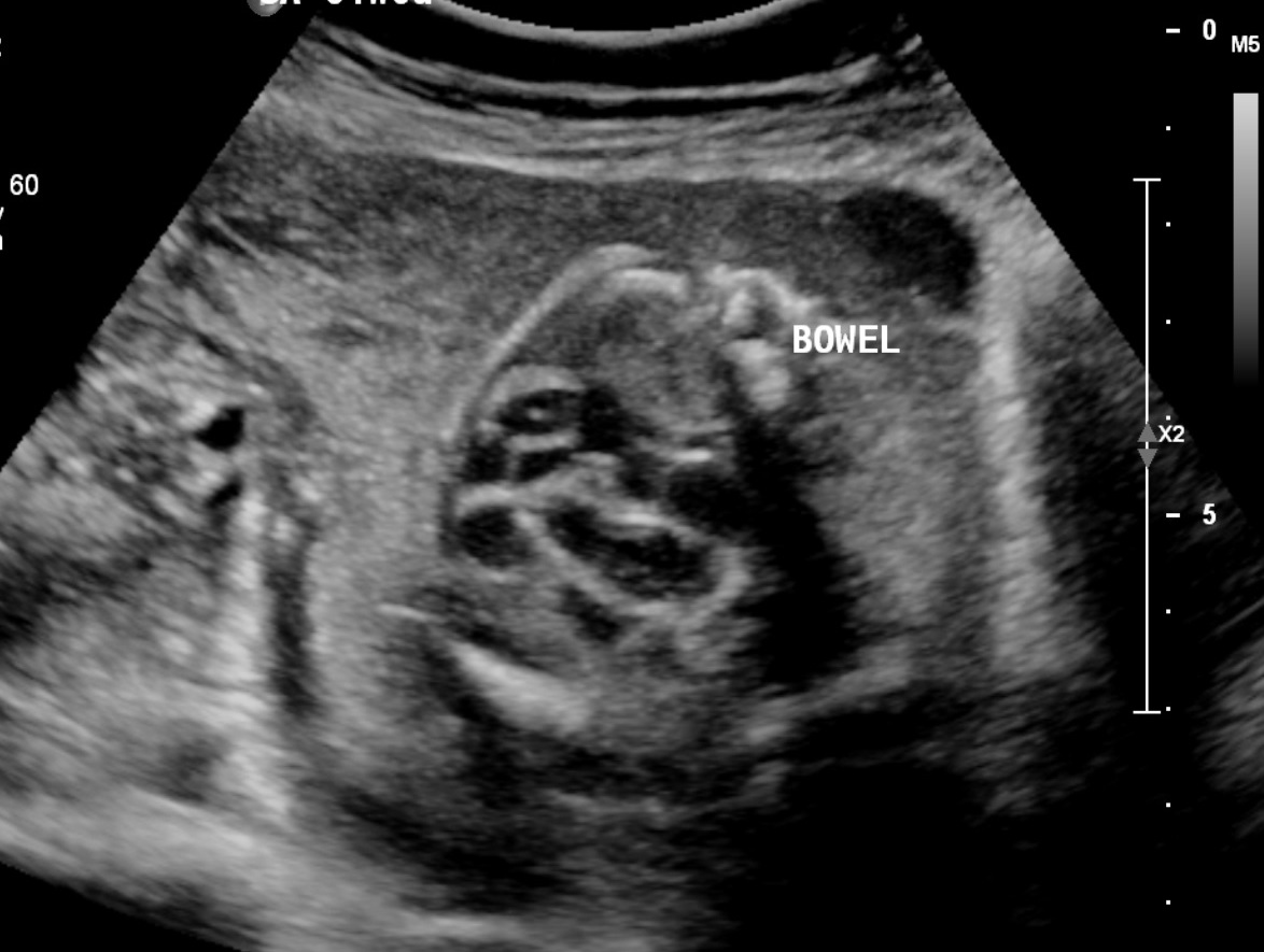 <p>Fetal Echogenic Bowel</p>