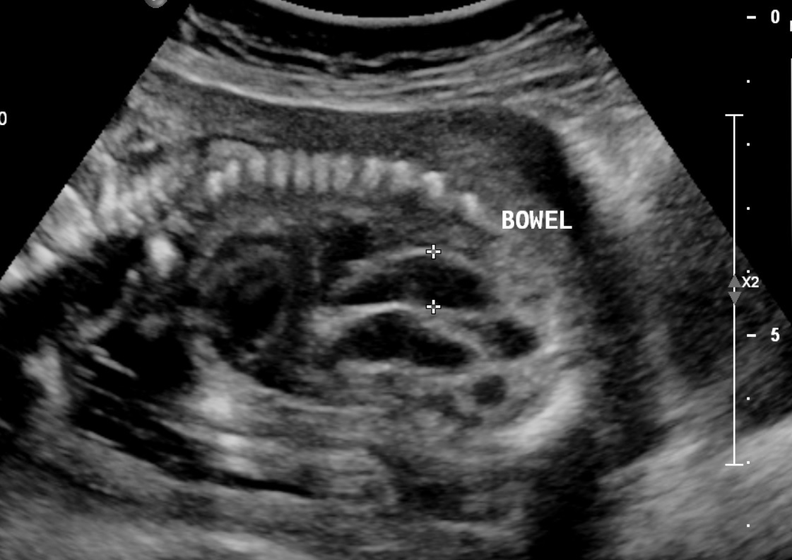 <p>Fetal Bowel Echogenicity</p>