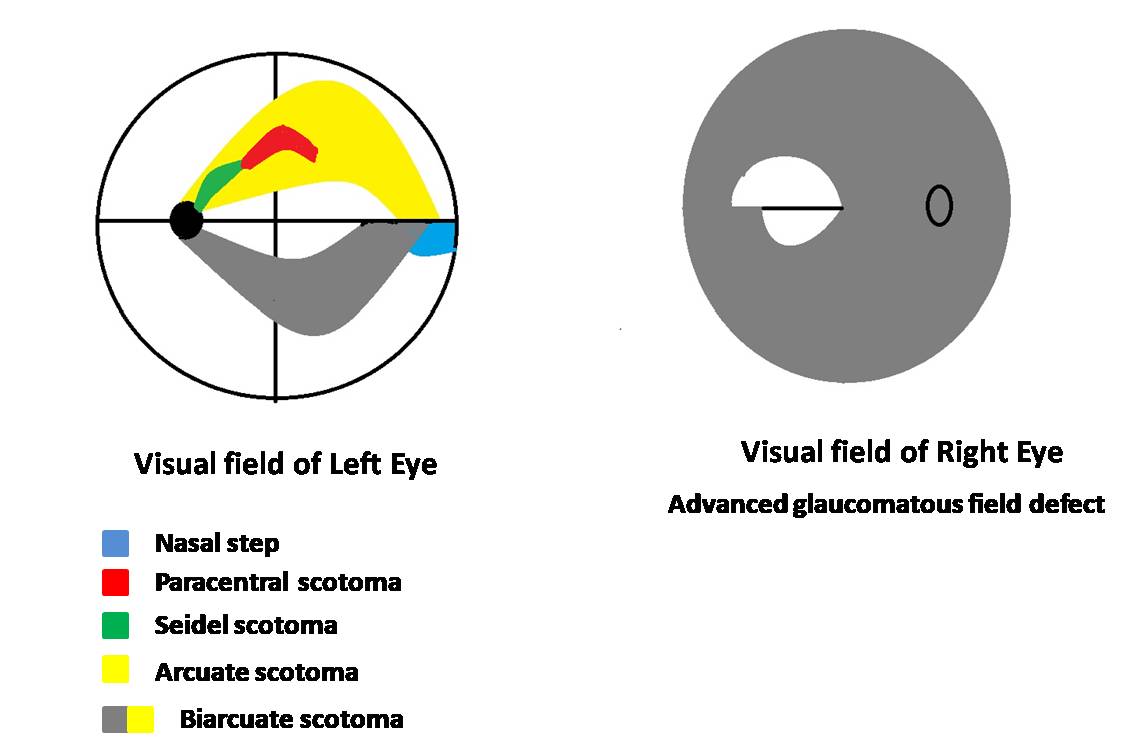 <p>Types of Field Defects in Glaucoma