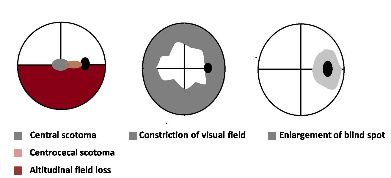 <p>Types of Visual Field Defects in Other Diseases