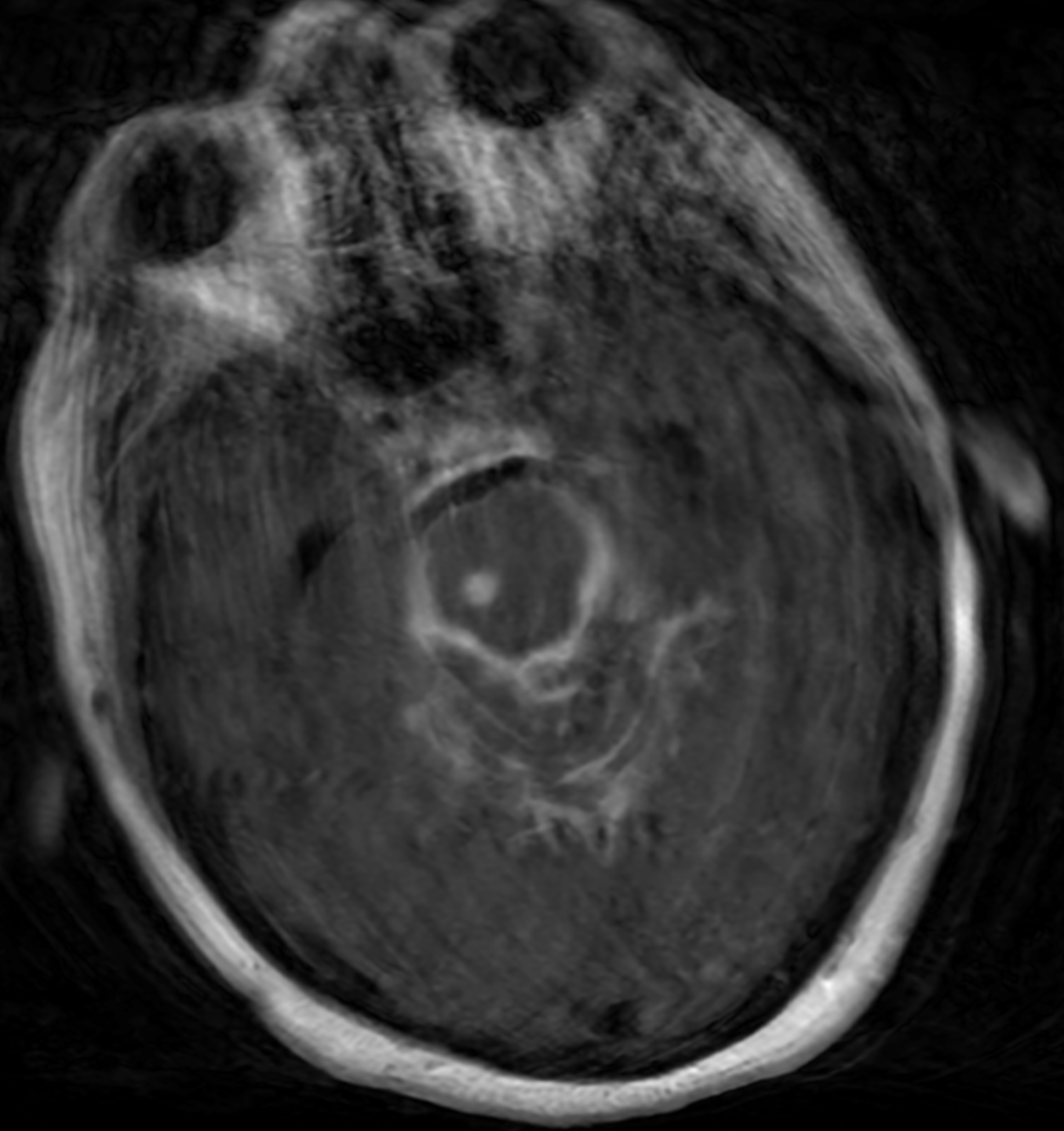 <p>Tuberculous Meningitis on Computed Tomography</p>