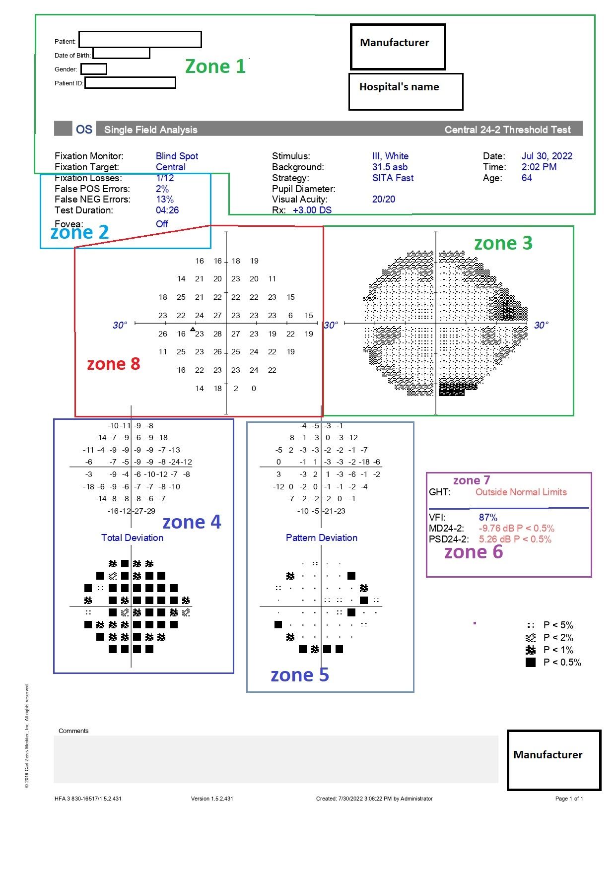 <p>Humphrey Visual Field Printout (24-2 Test) With Zones